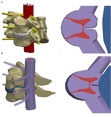 Finite Element Analysis of Spinal Cord Stress in a Single Segment Cervical Spondylotic Myelopathy